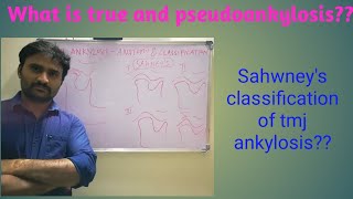 TMJ Ankylosis  anatomy and classification [upl. by Bianca268]