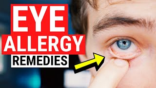 Eye Allergy Remedies  Tips for Itchy and Watery Eyes [upl. by Strephon]