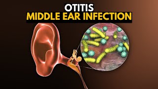 Middle Ear Infection Otitis Media Causes SIgns and Symptoms Diagnosis and Treatment [upl. by Jonathan]