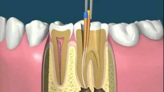Leczenie kanałowe [upl. by Sholes]