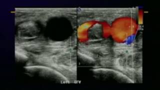 Lower Extremity Venous Protocols and Interpretation [upl. by Yennaiv390]