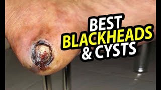 Largest Blackheads amp Cysts  Worlds Greatest Medical [upl. by Cuthbert]