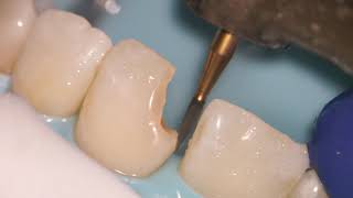 Teeth Bonding  Front tooth filling EXPLAINED [upl. by Obaza]