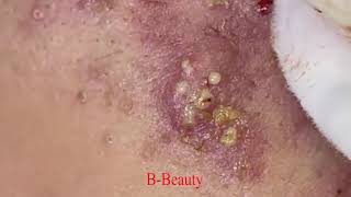 Pimple Removal and Acnes Treatment  BBeauty 07 [upl. by Ocram]