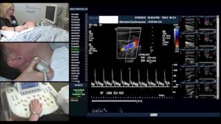 Carotid Protocol Esther Collado RN RVI [upl. by Akimal]