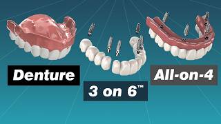 Alternative to Dentures Comparing Dentures Overdentures Allon4 and 3 on 6™ [upl. by Anaugal]