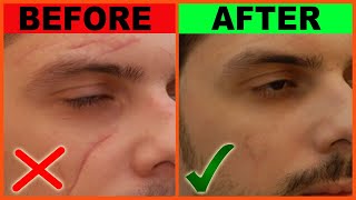 5 Minute DIY Scar Removal at Home  Remove Scars on Face and Body Naturally  No Laser Scar Remove [upl. by Eninaej789]