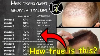 Hair Transplant growth timeline  Month 19  Norwood 5 [upl. by Lune]