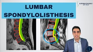 Lumbar Spondylolisthesis  Anatomy Symptoms Causes Treatments and more [upl. by Ardnnaed]