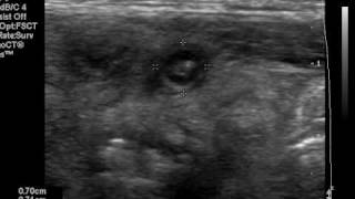 Ultrasound of acute appendicitis [upl. by Ilagam]