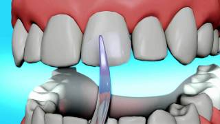 Dental Bonding Video  Tooth Bonding [upl. by Dutch753]