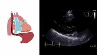 Mastering important TEE views transesophageal echocardiography [upl. by Lerat]