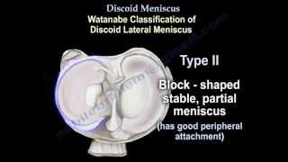 Meniscus Root Tears See It Fix It [upl. by Nylhtak]