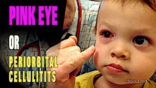 LIVE DIAGNOSIS Pink Eye or Periorbital Cellulitis  Dr Paul [upl. by Ajax]