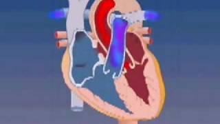 Ventricular Septal Defect Animation [upl. by Eikkin908]