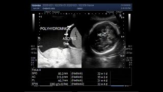 Ultrasound Video showing a Pregnancy of 32 weeks with Polyhydromnios ascites and sluggish fetus [upl. by Tharp]