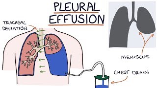 Understanding Pleural Effusions [upl. by Lehcin956]