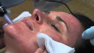 Dr Mark B Taylor Review of Dermapen Micro Needling  Gateway Aesthetics [upl. by Hefter894]