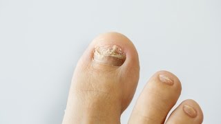 How to prevent and treat nail fungus [upl. by Ayardna]