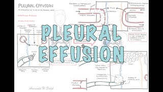 Pleural Effusion DETAILED  pathophysiology signs and symptoms treatment [upl. by Hellah]