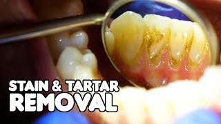 Dental Cleaning EXPLAINED  Stain amp Tartar Removal [upl. by Nelie532]