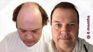 I Got A Hair Transplant In Turkey  Surgeon Reacts [upl. by Dow776]