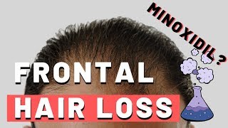 Frontal Hair Loss  Does Minoxidil Work [upl. by Eilrahc686]