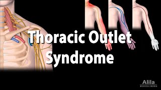 Thoracic Outlet Syndrome TOS Animation [upl. by Elockin84]