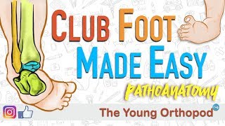 CLUB FOOT Pathoanatomy Made Easy  The Young Orthopod [upl. by Arlene]