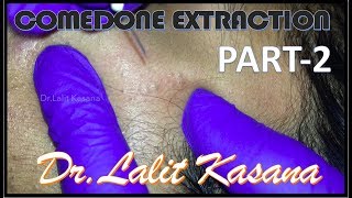 COMEDONE EXTRACTION by DrLalit Kasana PART2 [upl. by Clark]