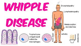 Whipples Disease [upl. by Vandervelde]