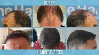 Clinic amp Hair Transplant Procedure Overview  Natural Transplants South Florida Dave [upl. by Ayvid]