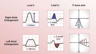 Intro to EKG Interpretation  Chamber Enlargement [upl. by Akehsyt]