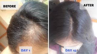 5 At Home Solutions For Scalp Hair Loss And Hair Thinning [upl. by Sage]