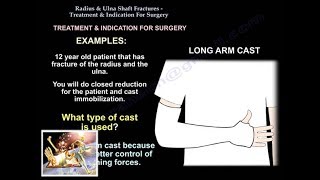 RadiusUlnar Shaft Fx Treatment Indication SurgeryEverything You Need To KnowDr Nabil Ebraheim [upl. by Leiram]