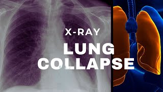 Xray in Lung Collapse [upl. by Analram164]