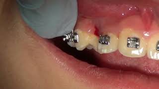 Baby Tooth Removal Method Los Angeles  8187760055 [upl. by Ted726]