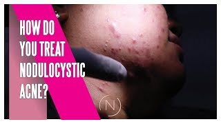 How Do You Treat Nodulocystic Acne  Houston Dermatology [upl. by Arihsan378]