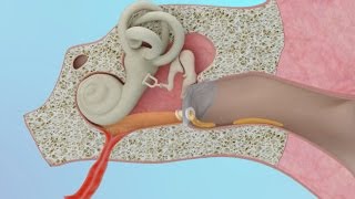 Tumours of Middle Ear and Mastoid  ENT Video Lecture  Doctors VLearning [upl. by Kamerman]