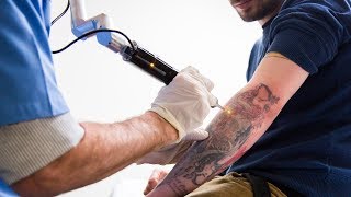 Tattoo Removal Laser Surgery [upl. by Aniraz323]