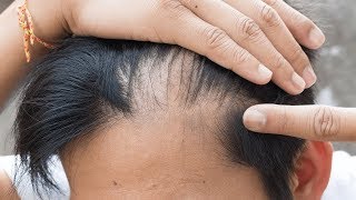 How to Use Castor Oil for Hair Growth [upl. by Pepin]