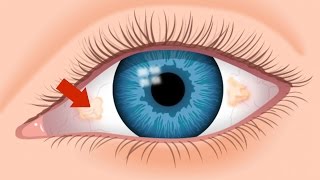 What Are The Ugly Yellow Spots In My Eye  An Optometrist Explains  True Eye Experts [upl. by Dewhirst]