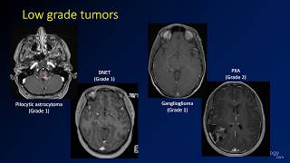 Imaging brain tumors  4  Other low grade gliomas [upl. by Chemosh177]