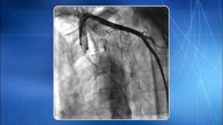 How To Ultrasound Guidance for Central Venous Access Part 1 Case Study [upl. by Eipper]