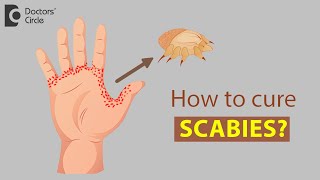 How to cure Scabies  Dr Rajdeep Mysore [upl. by Sudbury]