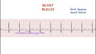 Heart Blocks Interpretation Easy and Simple [upl. by Washko690]