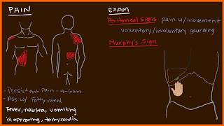 Acute Cholecystitis 23 [upl. by Rekab]