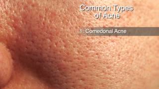 How to Treat Different Types of Acne [upl. by Cassell]