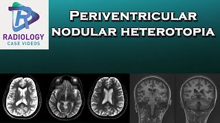 Periventricular nodular heterotopia [upl. by Gilba]