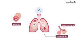 Was ist eine chronisch obstruktive Lungenerkrankung COPD [upl. by Adalard370]